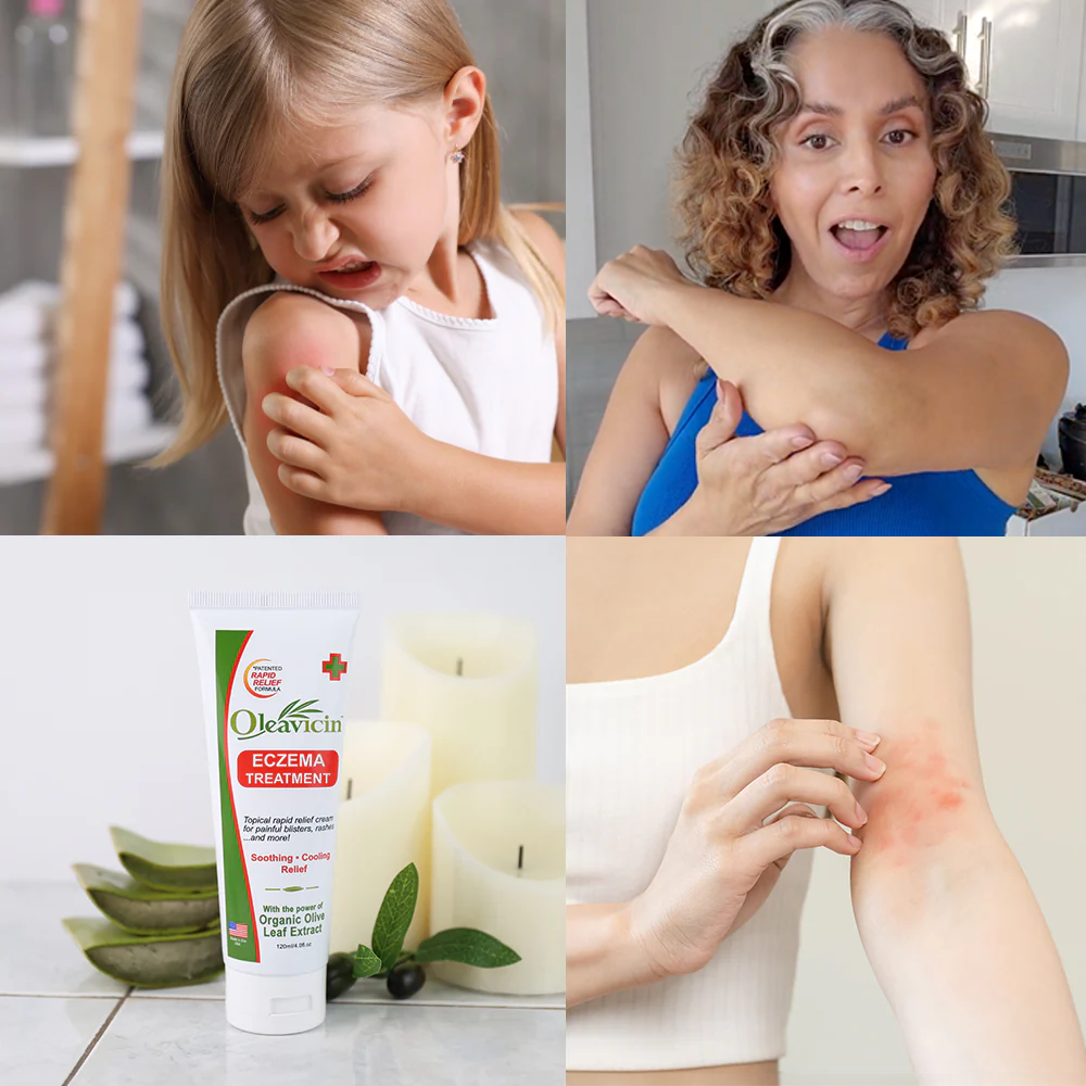 The Ancient Olive Leaf Secret That's Revolutionizing Eczema Relief